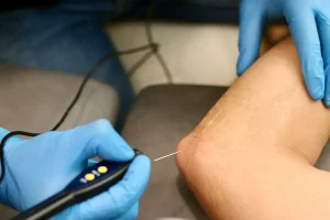 Tratamiento de fisioterapia con EPI para el codo, técnica avanzada para lesiones